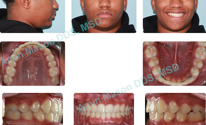 How Can I Speed Up My Invisalign Treatment