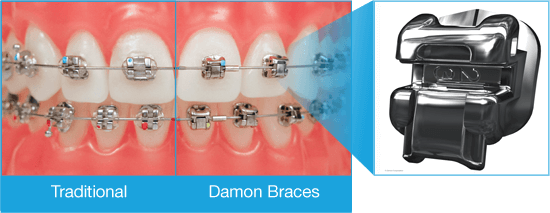 damon braces system empower self ligating