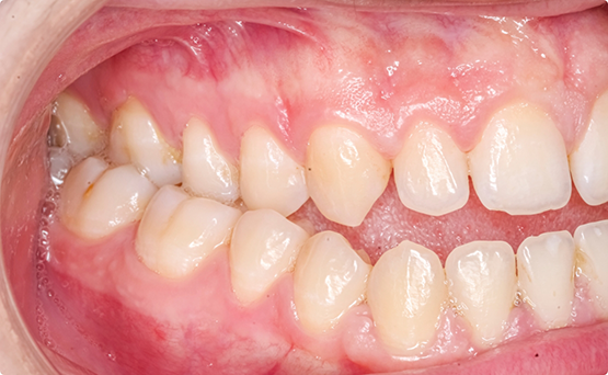 Mouth with an open bite