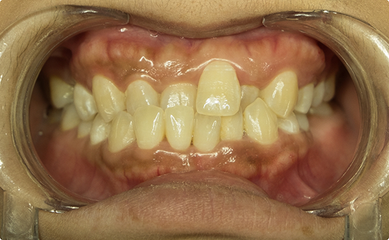 Mouth with a crossbite