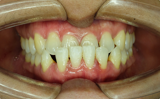 Mouth with an underbite