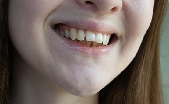 Young woman smiling with a significant overbite