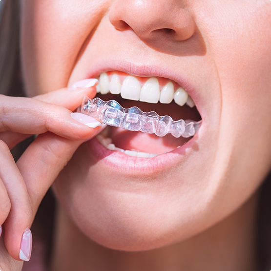 Person placing an Invisalign aligner over their teeth