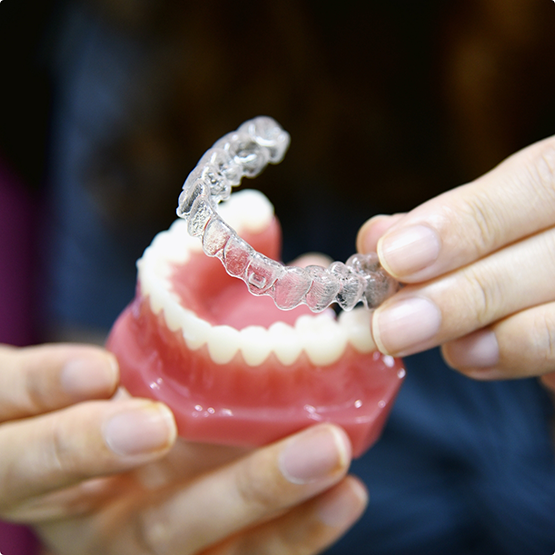 Orthodontist placing an Invisalign aligner over a model of the teeth