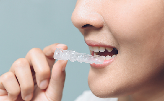 Close up of a person putting Invisalign over their teeth