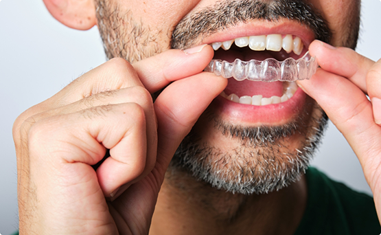 Man placing Invisalign over his teeth
