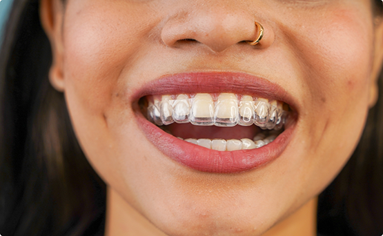 Close up of a woman smiling with Invisalign over her teeth