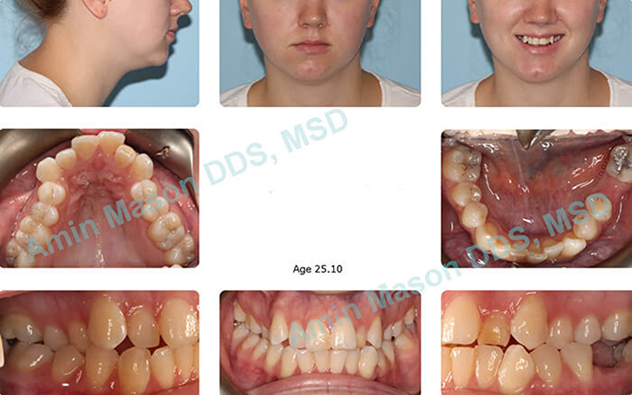 Collage of a woman's misaligned teeth before Invisalign in Columbus