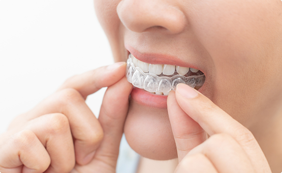 Close up of a person placing an Invisalign aligner over their teeth