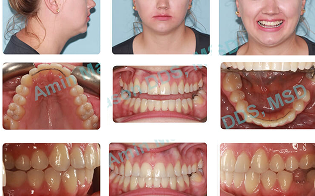 Collage of a woman's straightened teeth after Invisalign