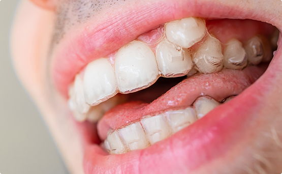 Close up of a man smiling with Invisalign over both arches