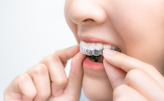 Close up of a person placing an Invisalign aligner over their teeth