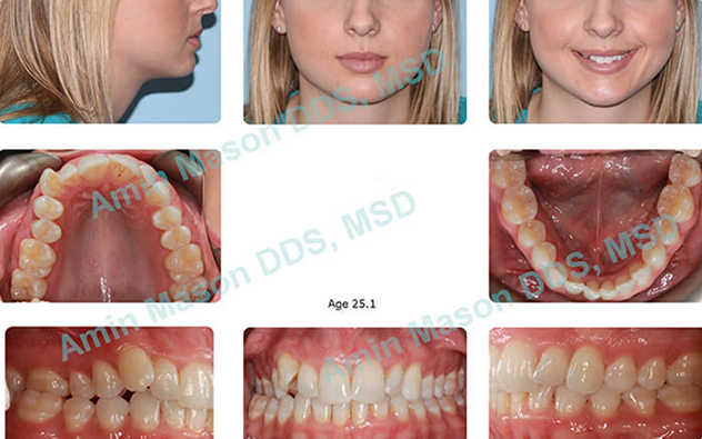 Collage of a patient's crowded and crooked teeth