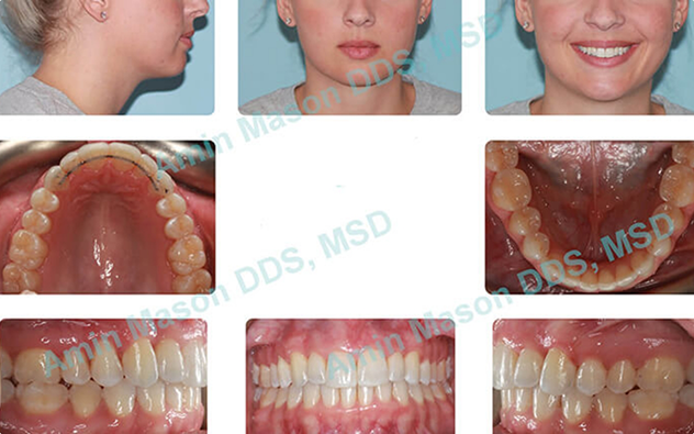 Collage of a patient's fully aligned teeth