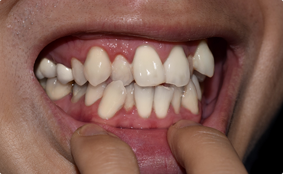 Mouth with crowded teeth