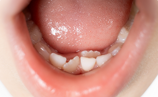 Mouth with a few rotated lower teeth