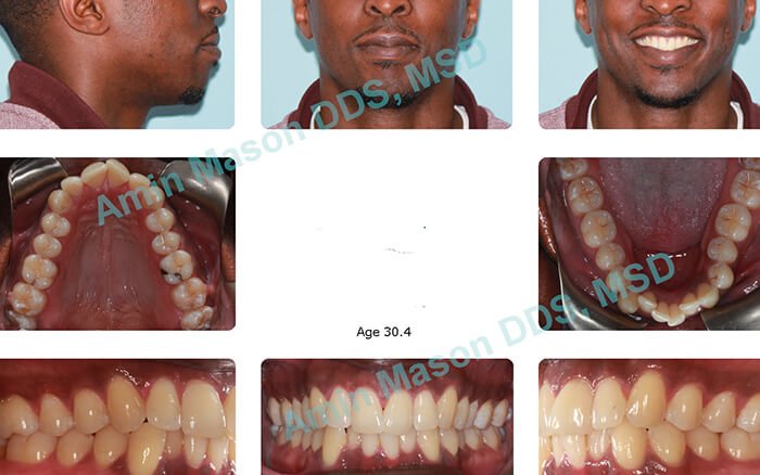 Lingual and Hidden Braces  Columbus Cosmetic Orthodontics