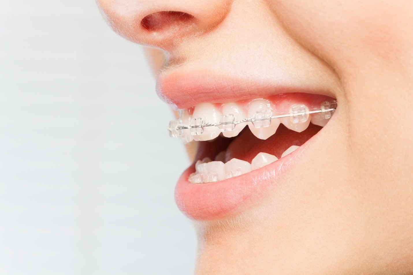 How Long do Clear Braces Take? - Fine Orthodontics